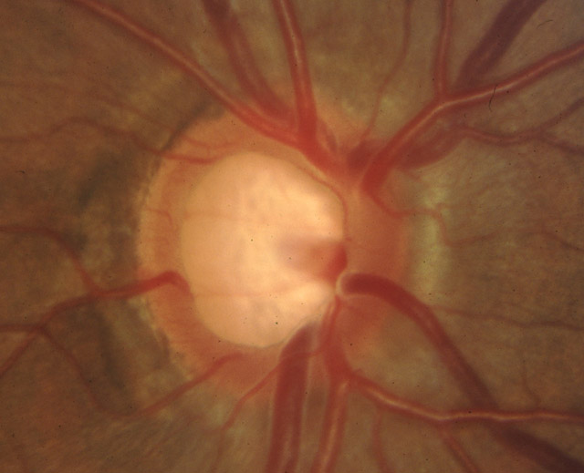 pe-glaucoma-01b