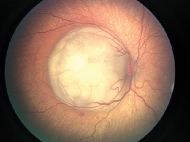 pe-retinoblastoma-01b