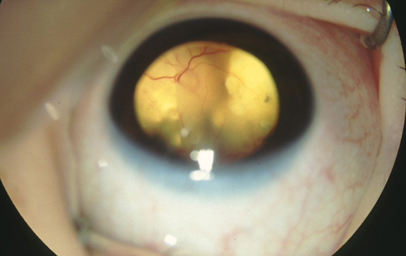 pe-retinoblastoma-02b
